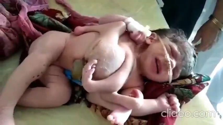 Mutant Vax Babies Being Born After Mothers Receive The Abomination-Jab