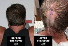 The Jab I Didn’t Want: Brain Surgery, Strokes, and My Permanent Scar of Regret before-after-jab