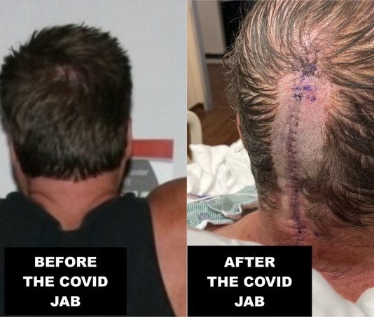 The Jab I Didn’t Want: Brain Surgery, Strokes, and My Permanent Scar of Regret before-after-jab