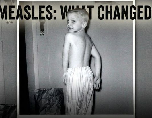 How Many People Have You Personally Known Who Died From Measles? greg-measles-what-changed